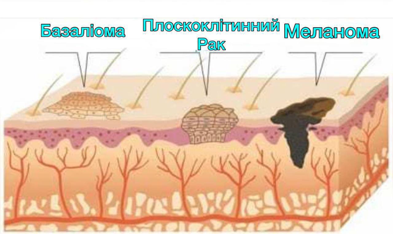 Распад кожи. Раковые образования на коже. Плоскоклеточная меланома.