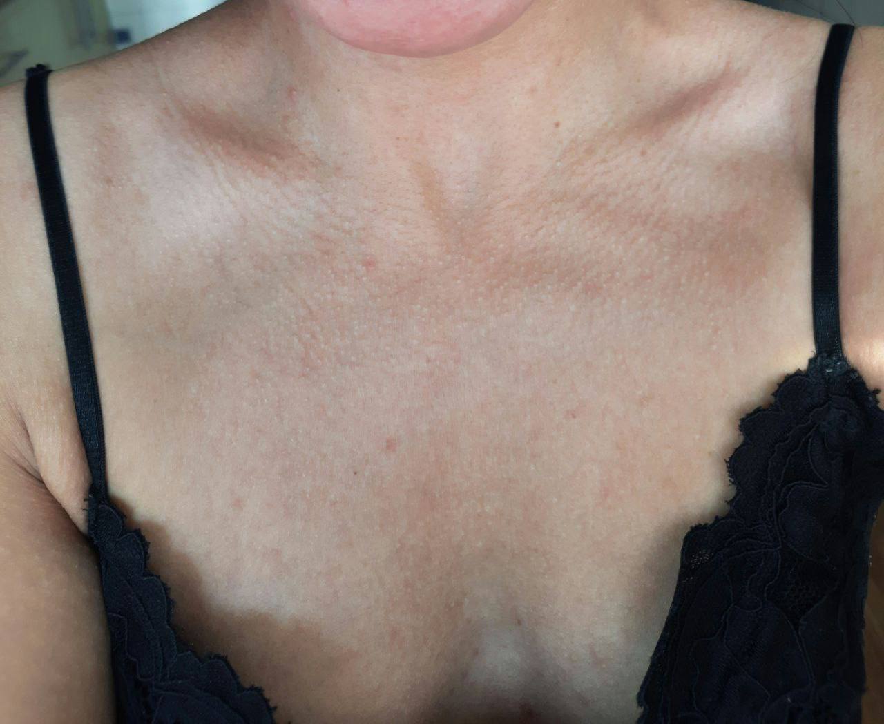 гусиная кожа на груди у женщин фото 53