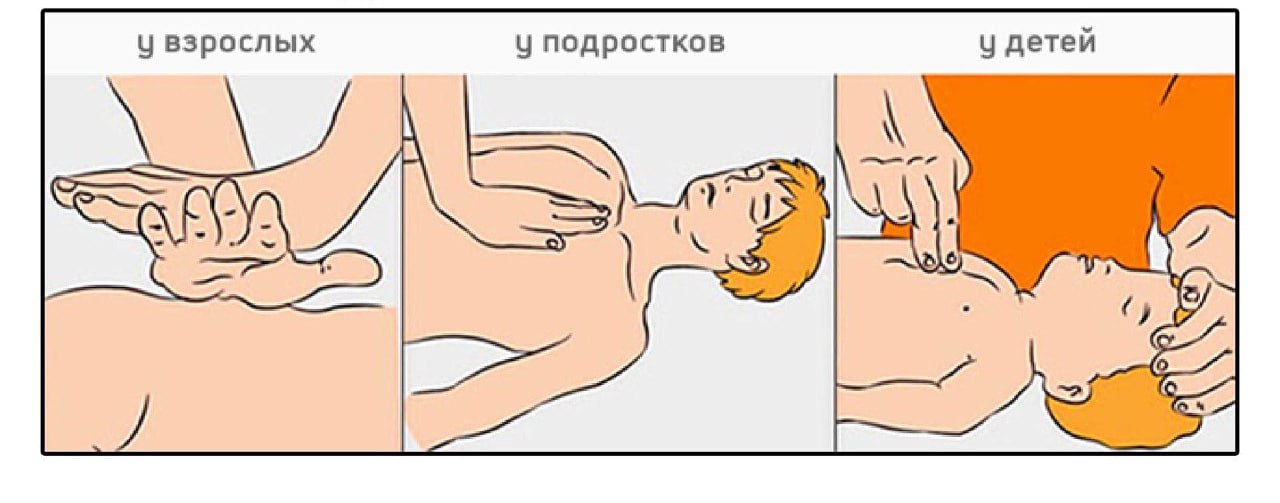 Непрямой массаж сердца место расположения рук
