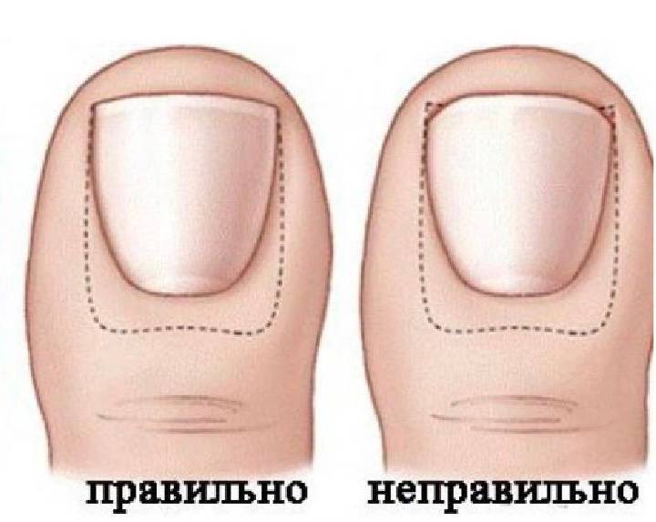 Как правильно срезать ноготь. Как правильно срезать ноготь